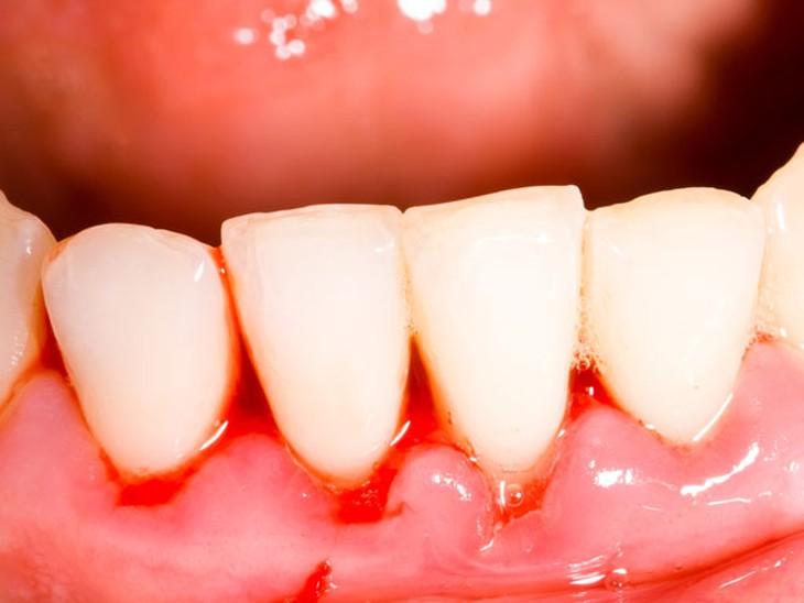 Người bệnh tiểu đường dễ mắc các bệnh về lợi