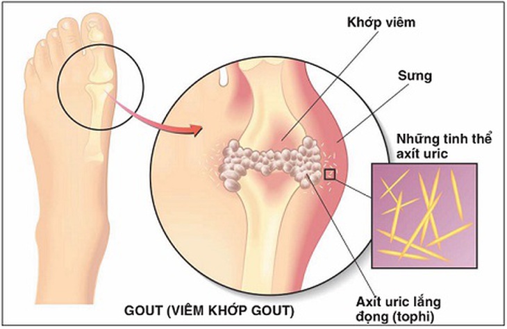 Acid uric lắng đọng ở khớp gây ra bệnh gút