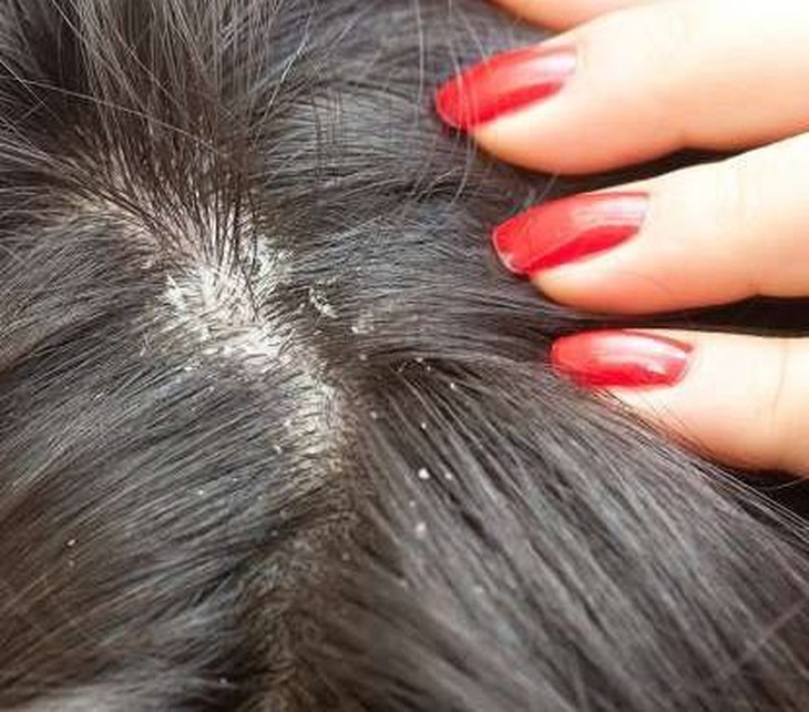 Ngứa da đầu có thể do gàu, vảy nến, dị ứng thuốc nhuộm tóc,...