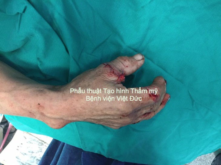 Kỳ diệu vi phẫu nối liền ngón cái đứt rời cho người lớn tuổi nhất từ trước tới nay_Ngón tay cái của bệnh nhân được nối liền ngay sau mổ
