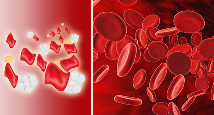 Triệu chứng bệnh Thalassemia