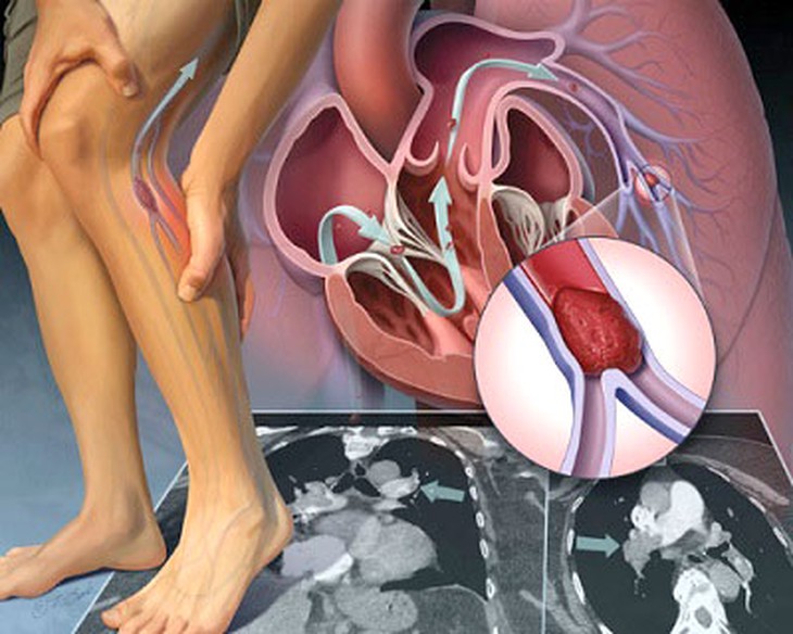 Phát hiện sớm tắc động mạch chi dưới, tránh tàn phế
