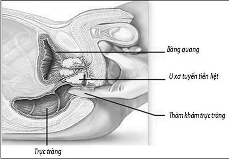 U xơ tuyến tiền liệt