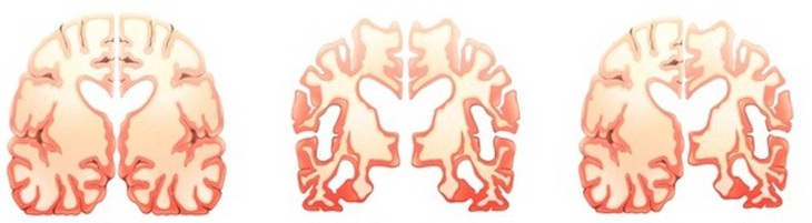 Não của người bình thường (ngoài cùng bên trái), não của người bệnh Alzheimer mức độ trung bình (giữa) và nặng.