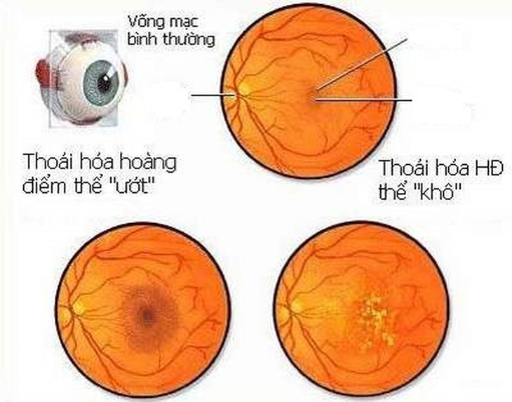 Cúc hoa vàng trị viêm thoái hóa hoàng điểm.
