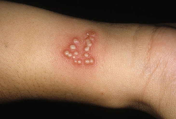 Nhiễm virut Herpes