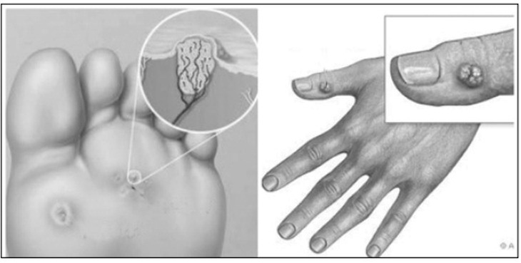 thuốc trị mụn cóc