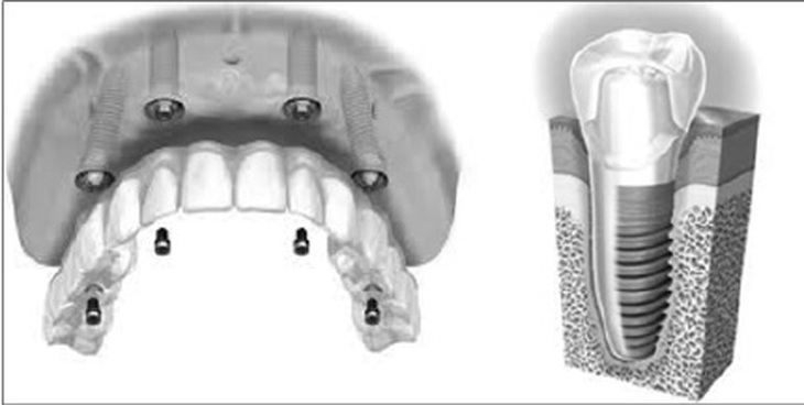 cấy ghép implant