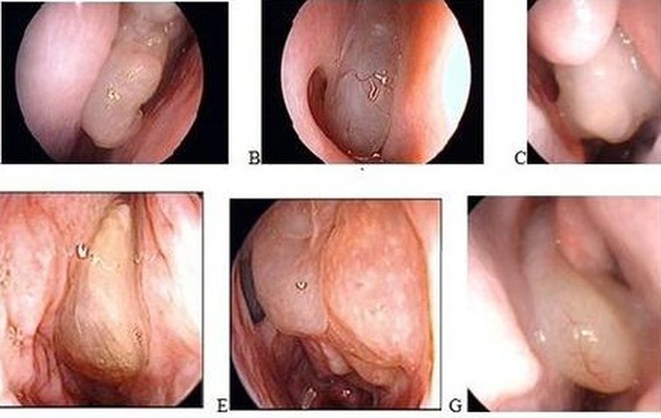 polyp mũi 