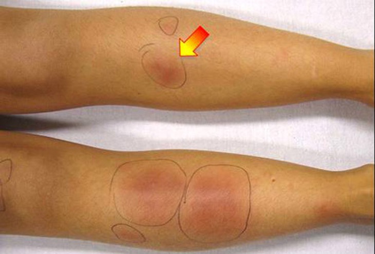 Dấu hiệu của hồng ban nút ở chi dưới.