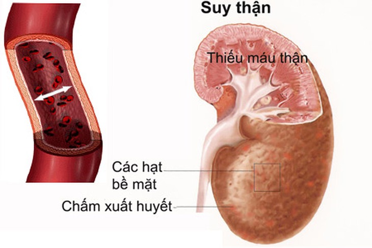 Bệnh thận