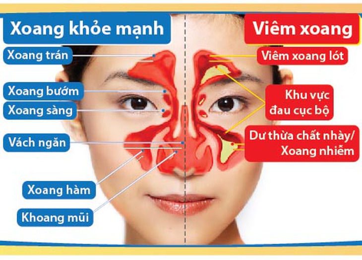 viêm xoang dị ứng