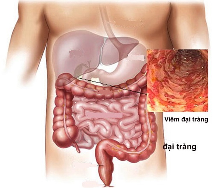 Hội chứng ruột kích thích dễ bị chẩn đoán nhầm với viêm đại tràng.