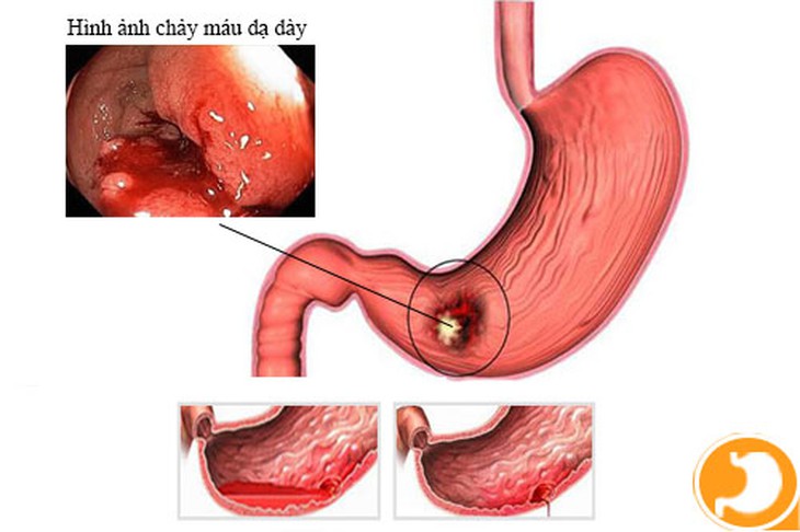 Nôn ra máu có thể do xuất huyết dạ dày.