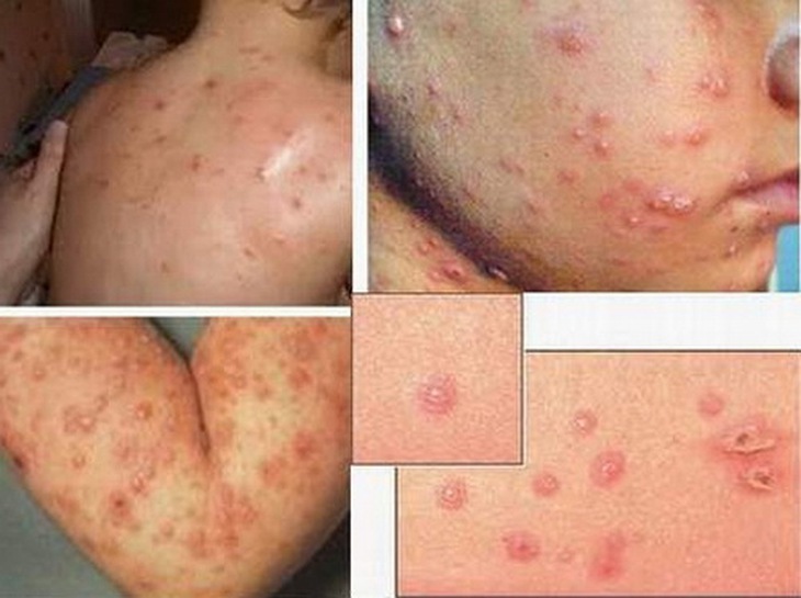 Thủy đậu bội nhiễm.