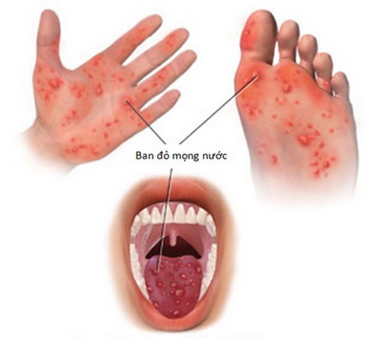 Tổn thương trong bệnh tay - chân - miệng.