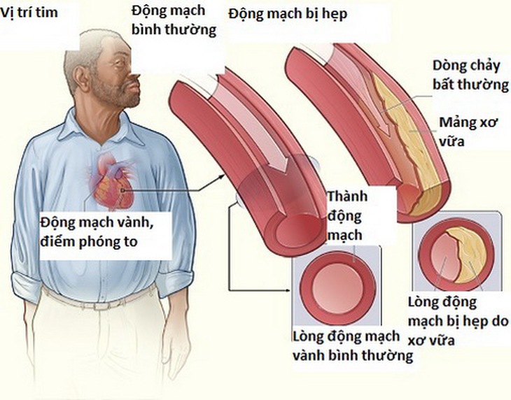 Hẹp động mạch gây những cơn đau thắt ngực ổn định.