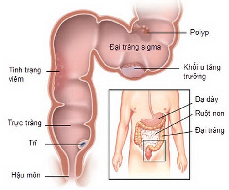 Viêm đại tràng xích - ma gây ảnh hưởng không nhỏ đến sức khỏe người bệnh.