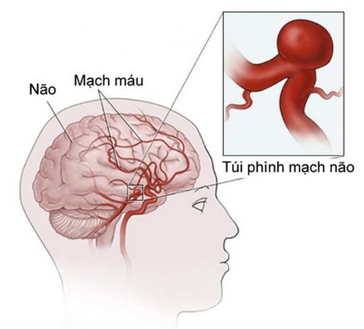 Túi phình mạch não.