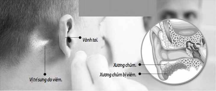 Hình ảnh xương chũm bị viêm ở tai.