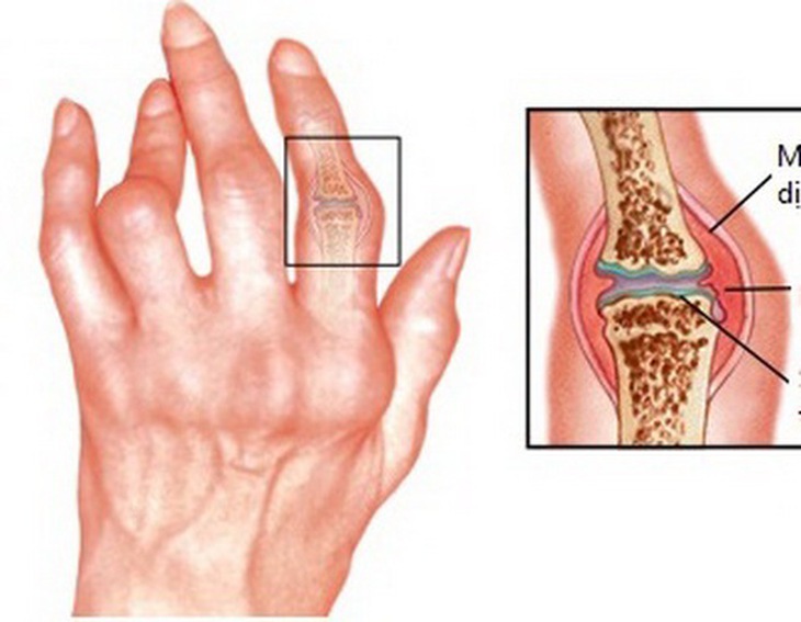 Hình ảnh bàn tay ở người viêm khớp dạng thấp.