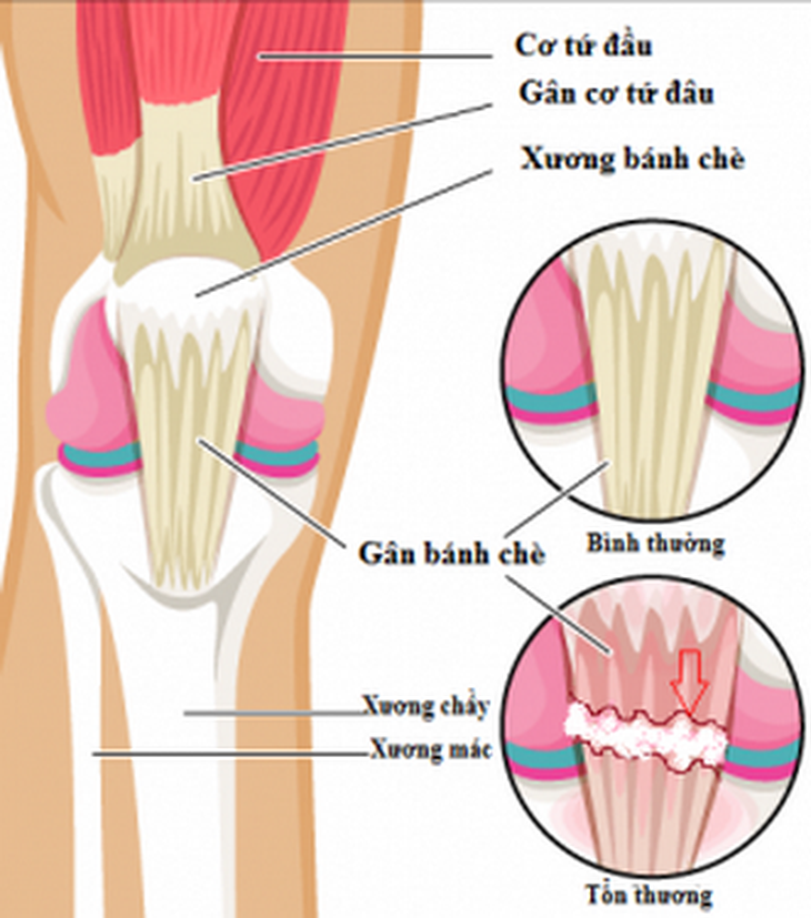 Khi thấy đau đầu gối cần đến cơ sở y tế để được khám và tư vấn cụ thể.