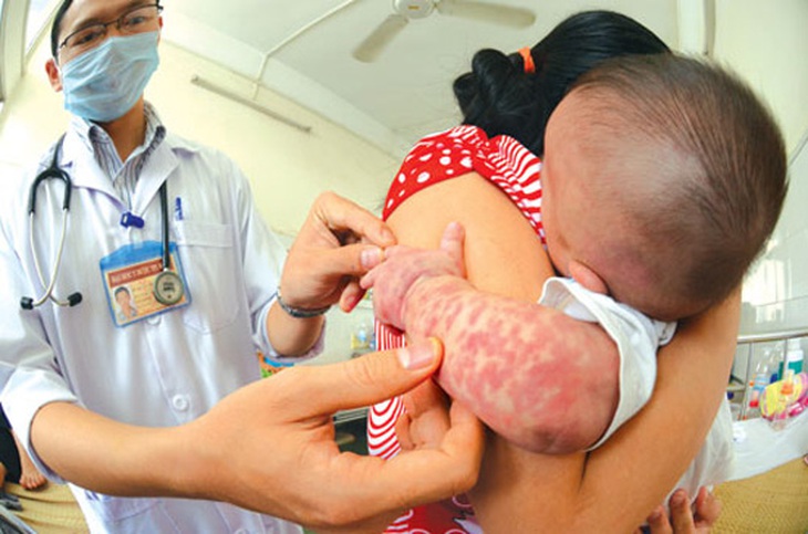 Nhận biết sốt phát ban dạng sởi