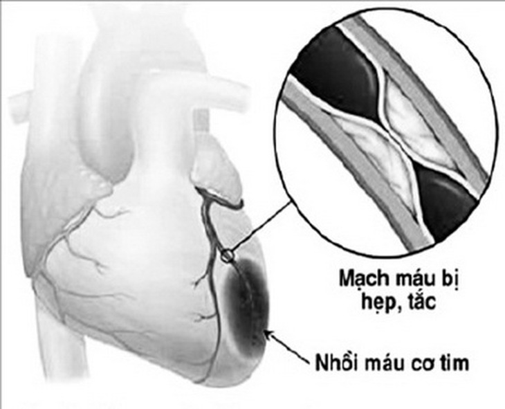 Mất ngủ kéo dài gây tăng huyết áp, nguy cơ nhồi máu cơ tim.