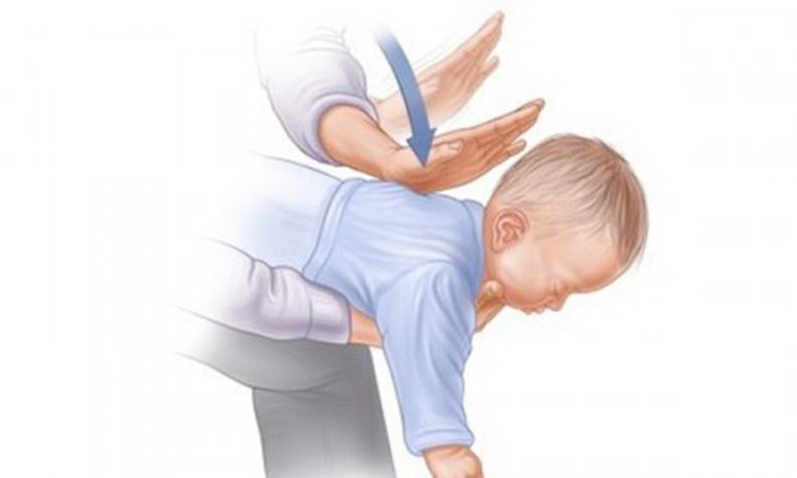 Thủ thuật Heimlich cấp cứu trẻ khi bị dị vật đường thở.