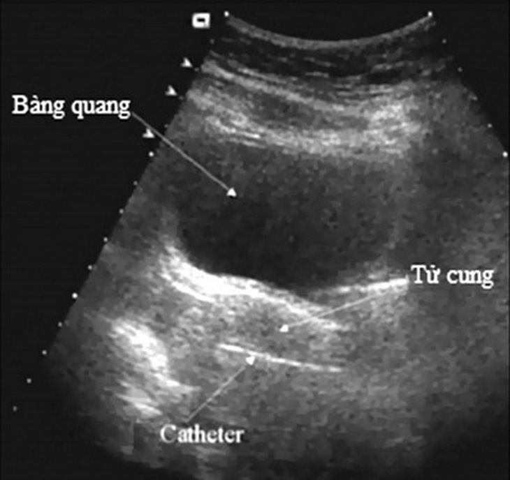 Siêu âm giúp đo được kích thước tử cung bình thường hay nhi hóa.