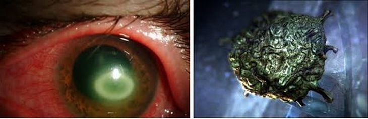 Ký sinh trùng Acanthamoeba trong mắt.