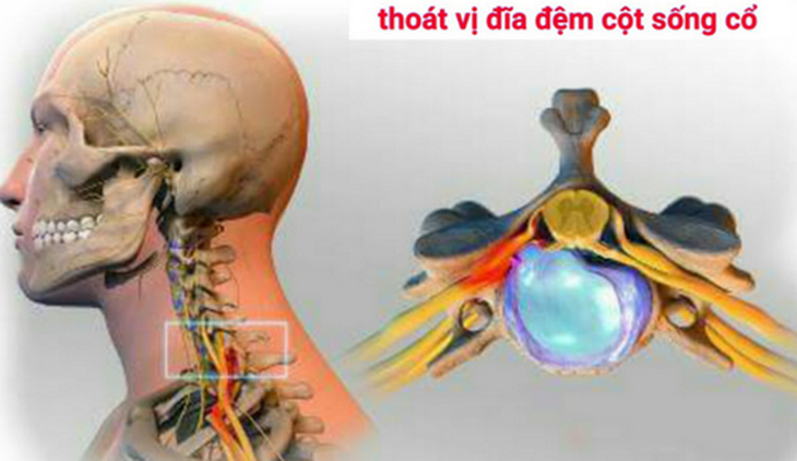 Hình ảnh thoát vị đĩa đệm cột sống cổ.