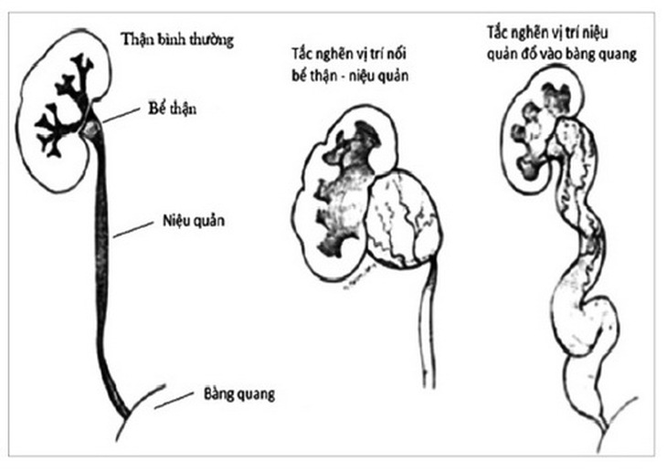 Một số hình ảnh tắc nghẽn đường niệu.