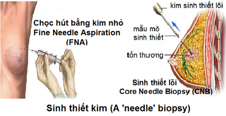 Sinh thiết xét nghiệm ung thư vú.