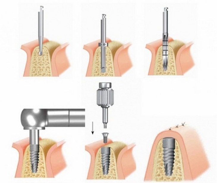 Quá trình cấy Implant nha khoa.