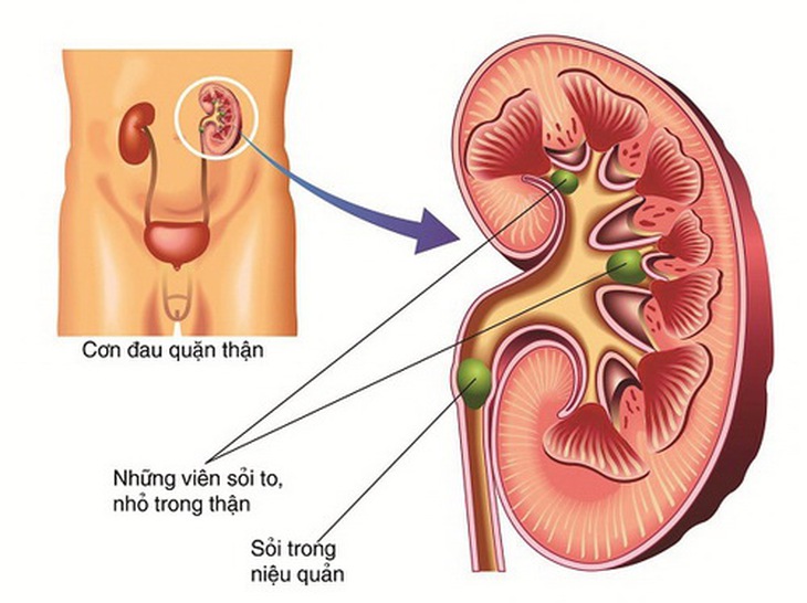 Sỏi niệu quản - nguyên nhân gây cơn đau quặn thận.