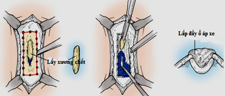 Phẫu thuật điều trị viêm xương.