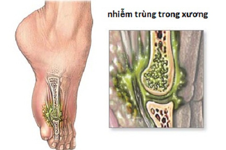 Tác nhân nhiễm trùng theo mạch máu đi vào xương.