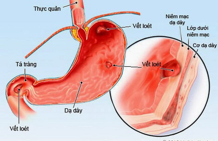 Viêm dạ dày không được điều trị dễ dẫn đến loét dạ dày.
