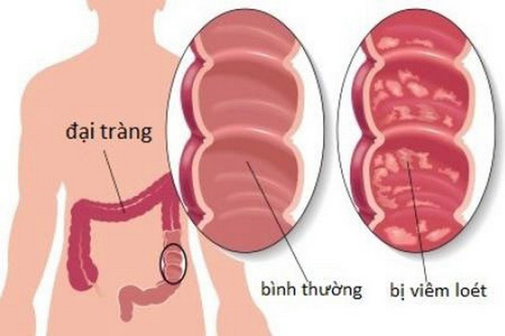 Khi bị viêm đại tràng, cần đi khám và tuân thủ điều trị của bác sĩ chuyên khoa.