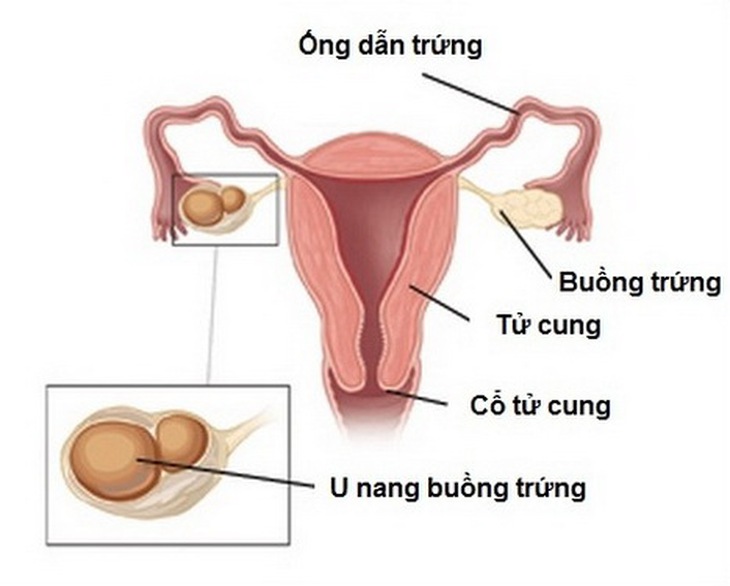 Hình ảnh u nang buồng trứng.