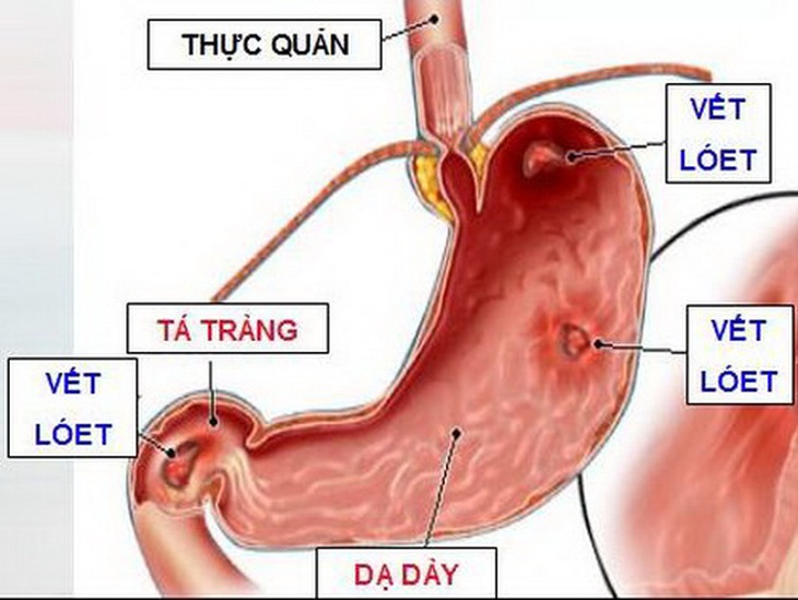 Hình ảnh viêm loét dạ dày.