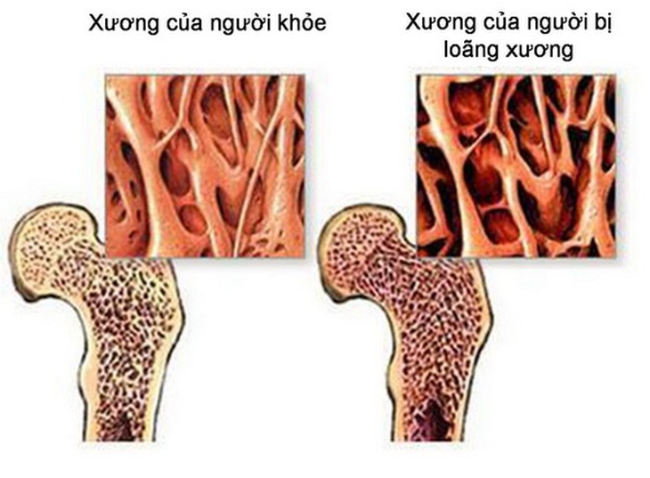 Loãng xương là tình trạng giảm mật độ xương và tổn thương vi cấu trúc xương.