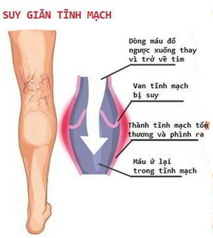 Hình ảnh suy giãn tĩnh mạch.