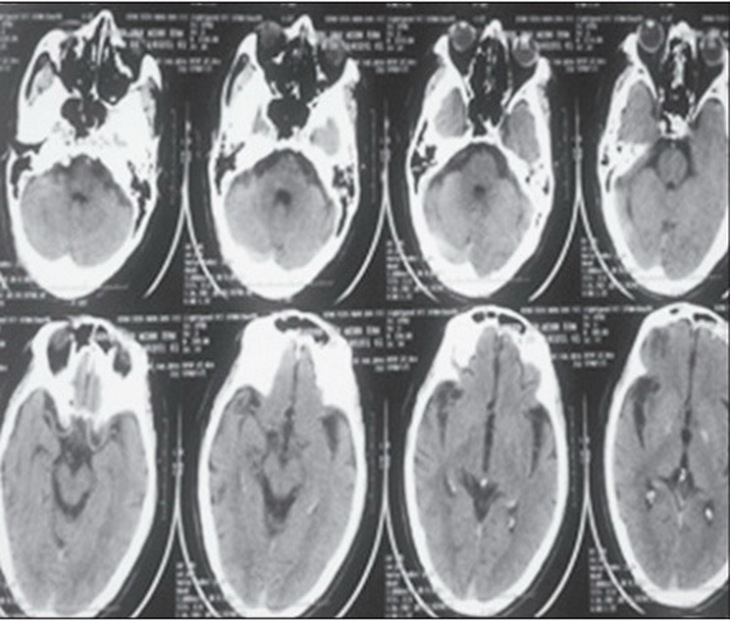 Hình ảnh chụp MRI ở bệnh nhân huyết khối tĩnh mạch não.
