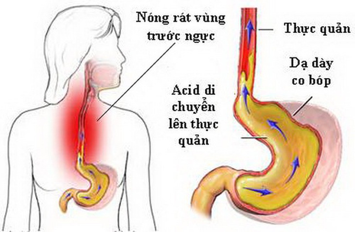 Hình ảnh viêm thực quản.