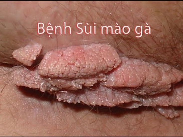 Tổn thương của sùi mào gà có khi là đám sợi nhỏ, hoặc đám sùi to.