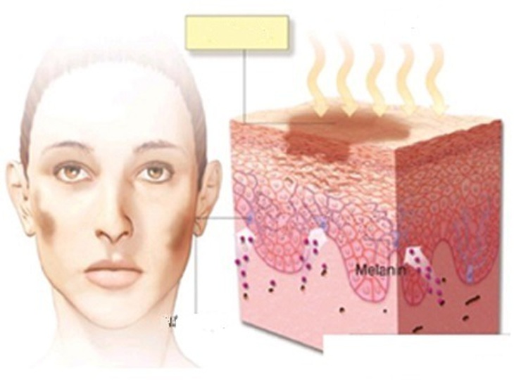 Tăng sản xuất hắc tố melanin gây nám da.