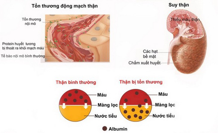 Tăng huyết áp và biến chứng suy thận.