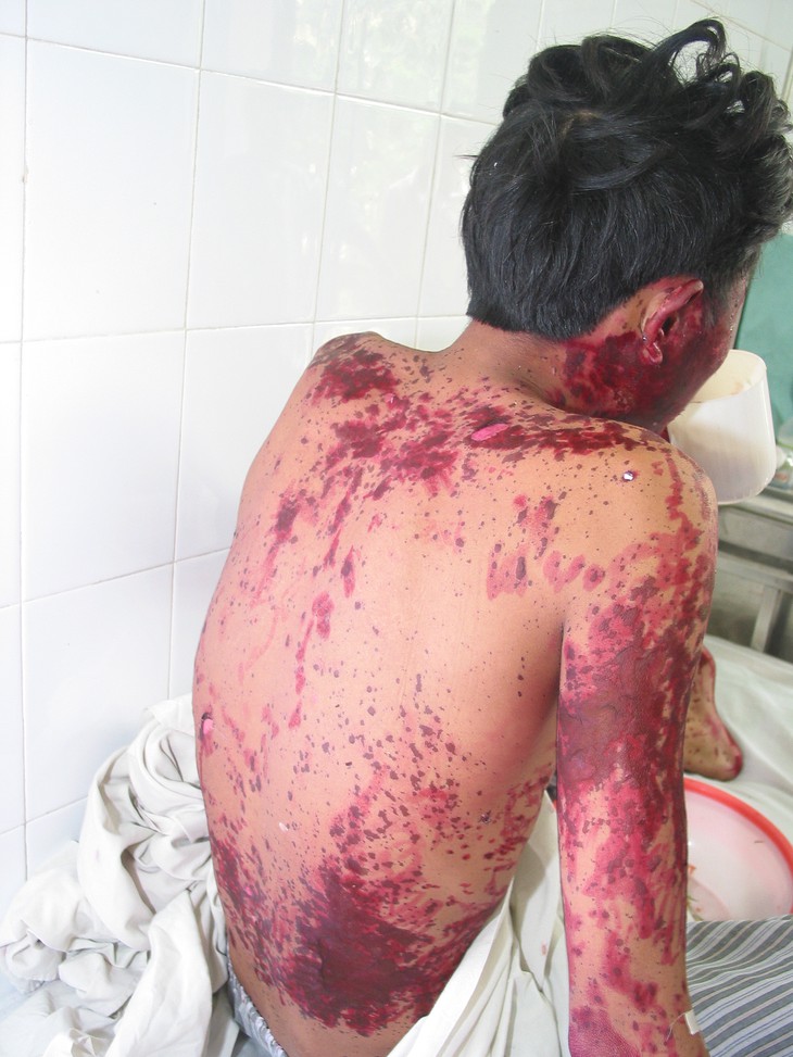 Một bệnh nhân bị ngộ độc thuốc Nam. Ảnh: TM